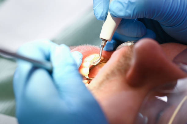 Best Emergency Root Canal Treatment in East Niles, CA